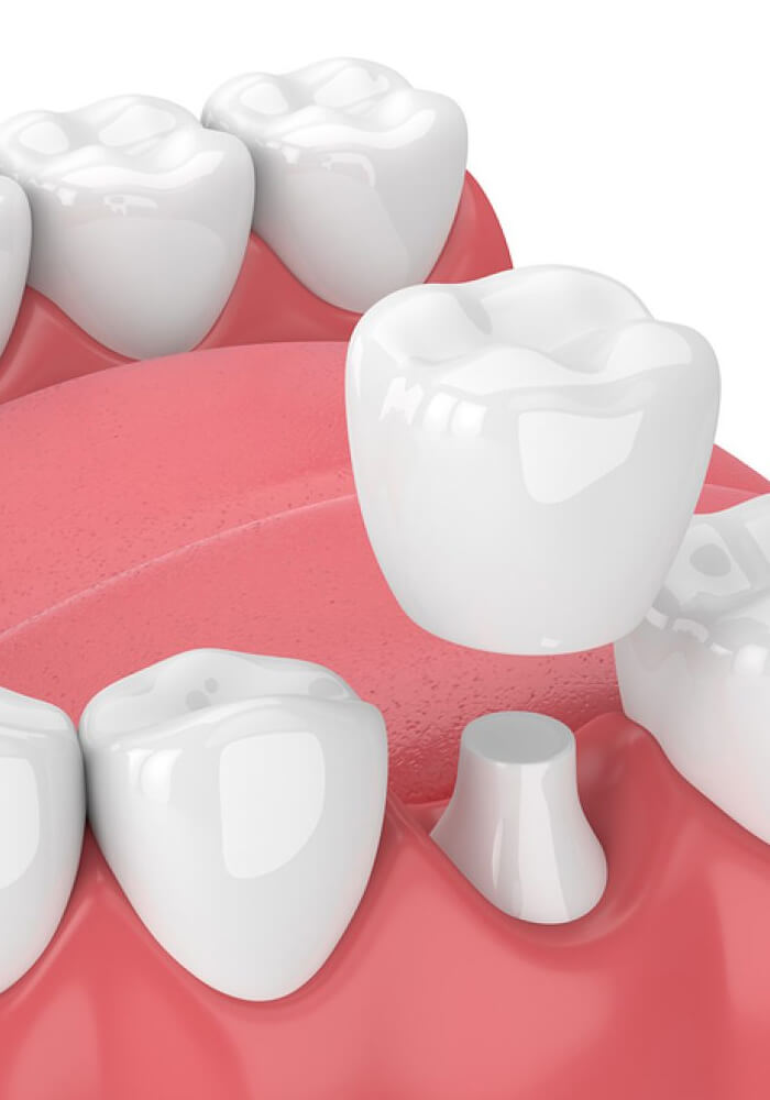 DENTAL CROWNS