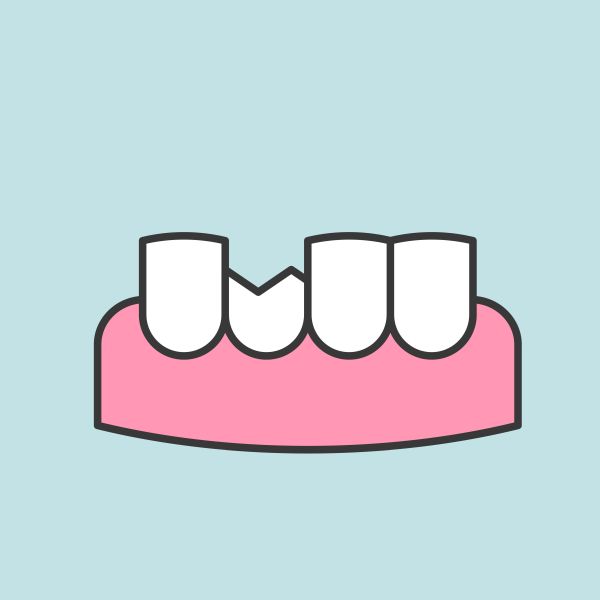 5 Ways to Ensure Broken or Chipped Teeth are Fixed