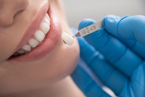 Can You Whiten Dental Veneers?