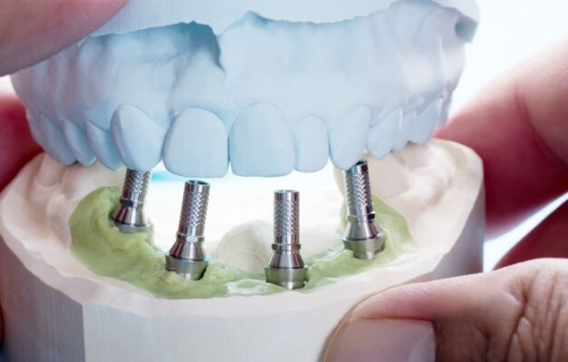 All on 4 Dental implants