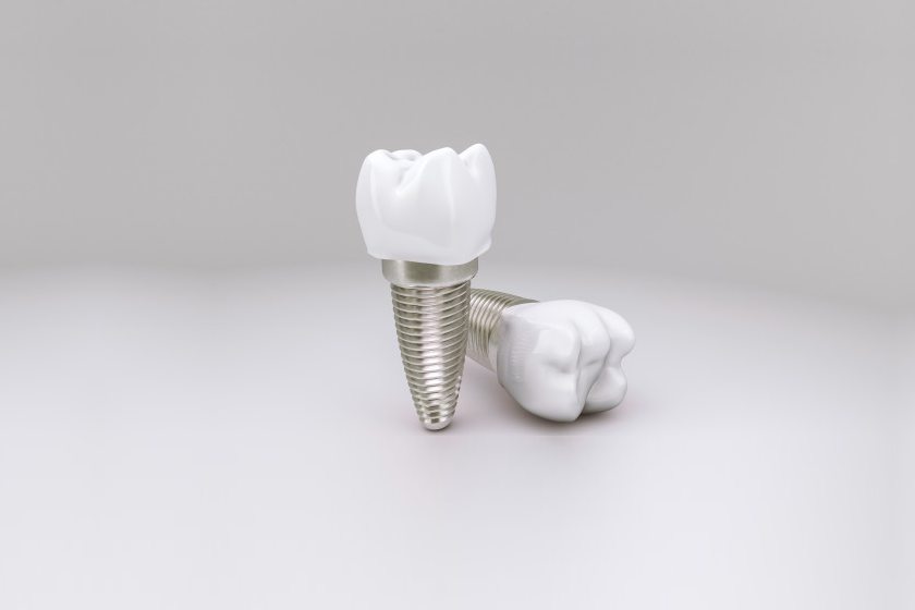 5 Benefits of Choosing Dental Implants