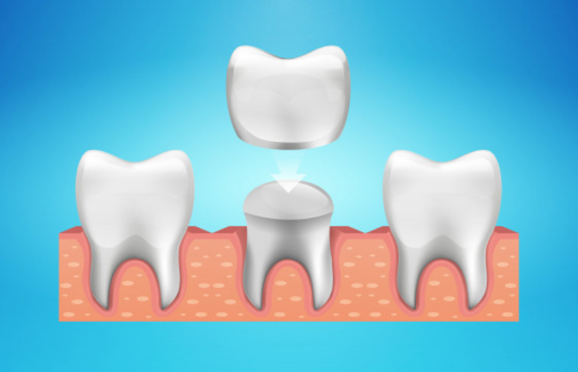 Revive Your Smile with Dental Crowns in Irving, TX
