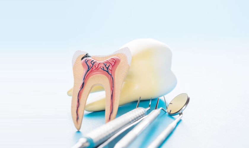 How a Root Canal Treatment is Done in 5 Simple Steps