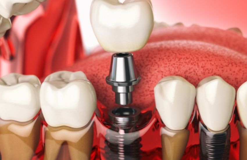 What is the price of dental implants?