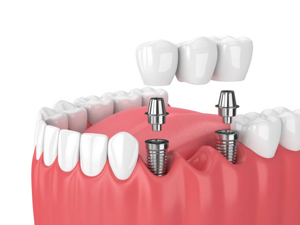 How To Care For Your Dental Implants?