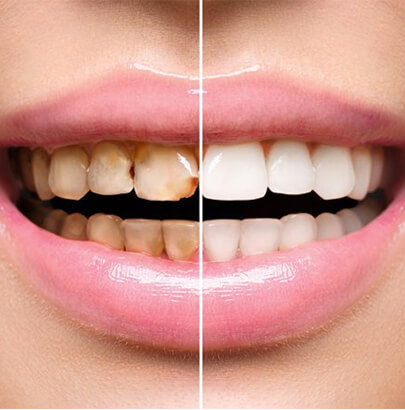 Know Important Details About Full Mouth Reconstruction