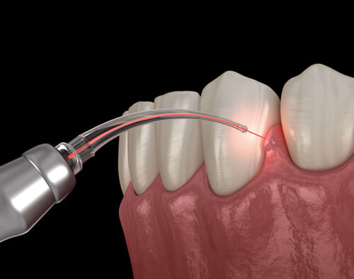 img-Why-Choose-Laser-Whitening