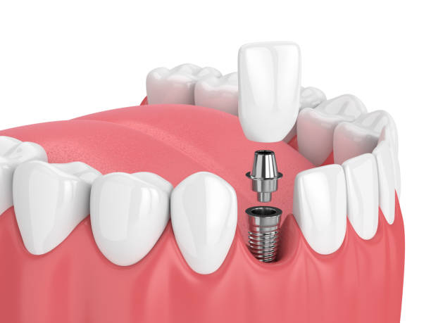 The Ultimate Guide to Dental Implants: All that you need to know