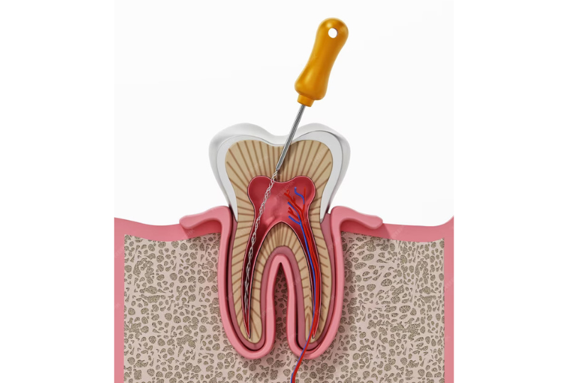 Emergency Root Canals: When and Why They’re Necessary?