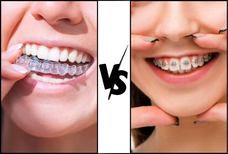 Invisalign vs.Traditional Braces: Making the Right Choice for You - Dental Artistry Irving