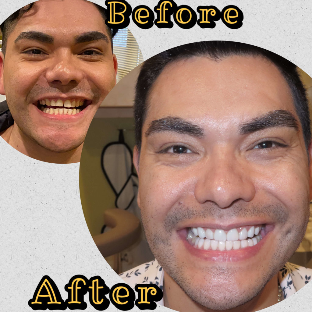Before and After - Veneers in Irving, TX