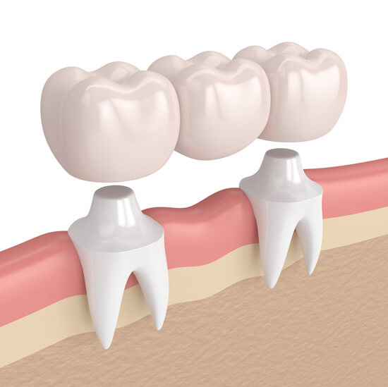 Benefits - Metal-Free Crowns and Bridges in Irving, TX