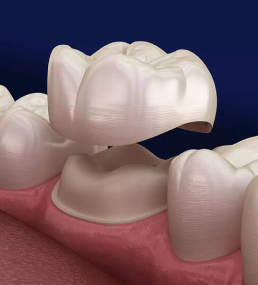 Dental Crowns - Dental Artistry Irving