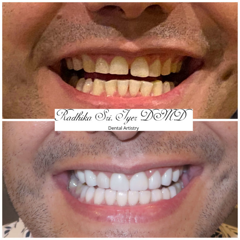 Dental Treatment Result - 2 - Dental Artistry Irving