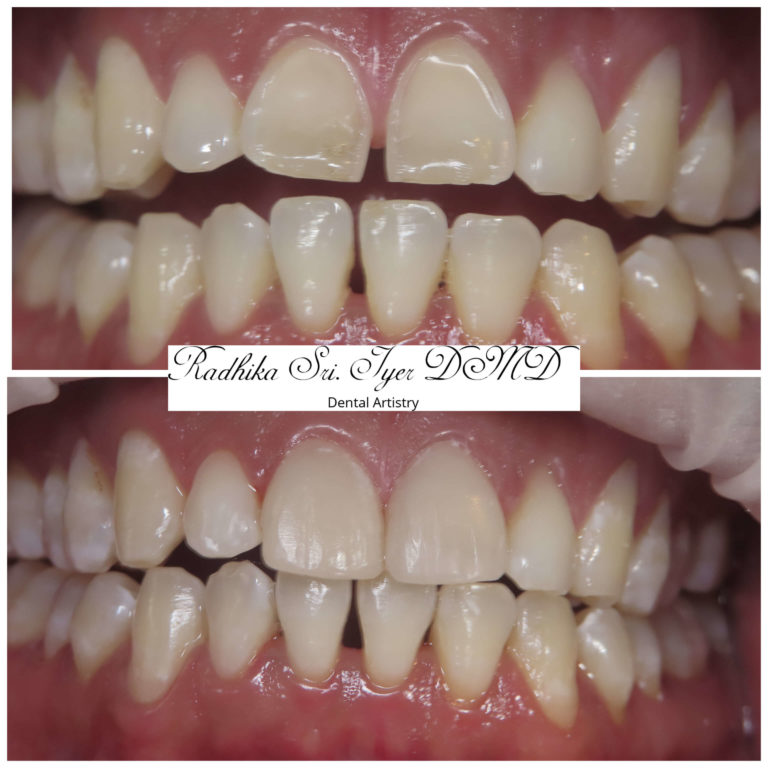 Dental Treatment Result - 3 - Dental Artistry Irving