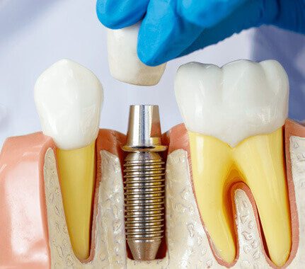 Facts - Biomimetic Restorations in Irving, TX - Dental ArtistryFacts - Biomimetic Restorations in Irving, TX - Dental Artistry