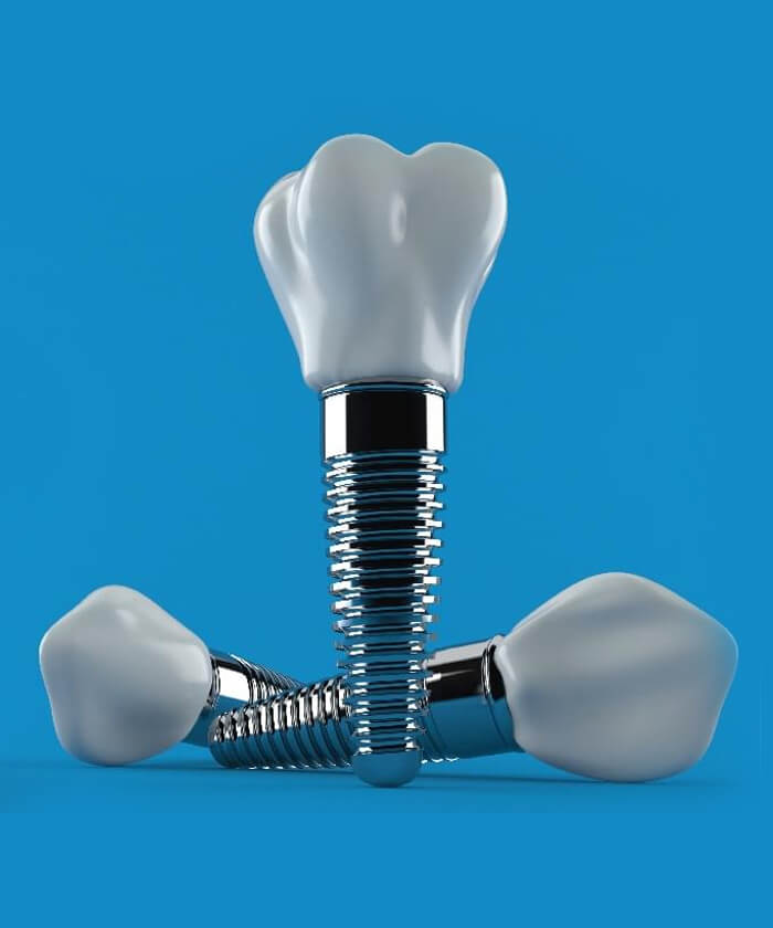Implants - Smile Makeover in Irving, TX - Dental Artistry