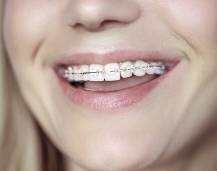 Why Choose -  Esthetic Orthodontics in Irving, TX