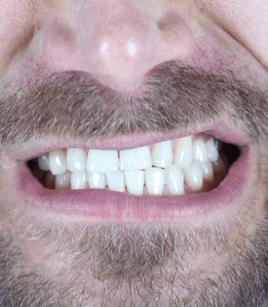 Facts About Bruxism - Dental Artistry - Irving, TX
