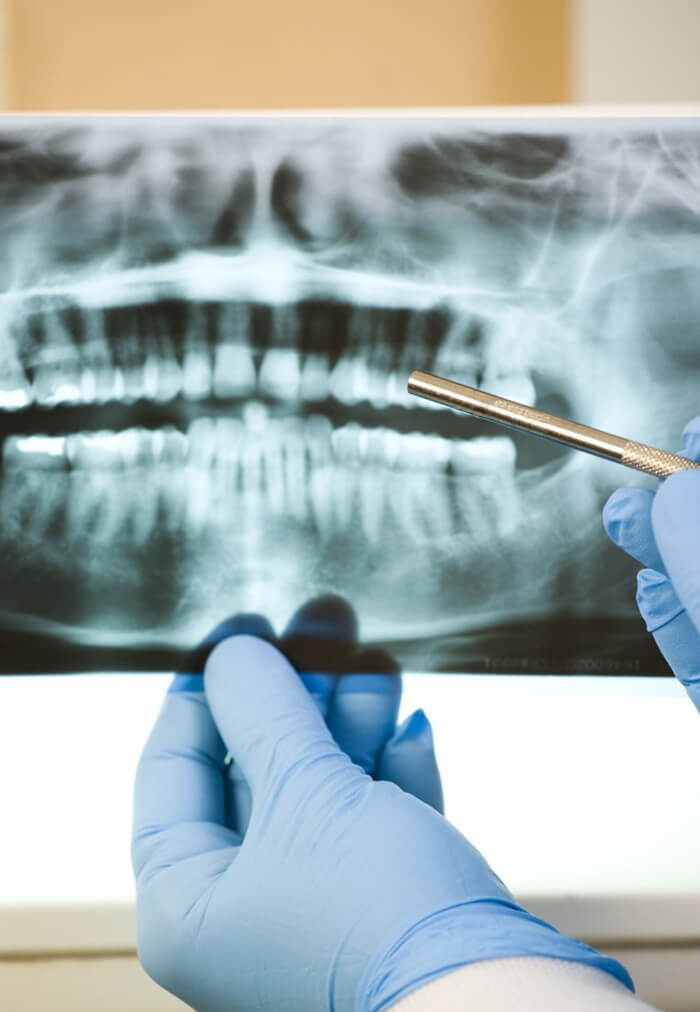 Why You Need - Root Canal Treatment in Irving, TX