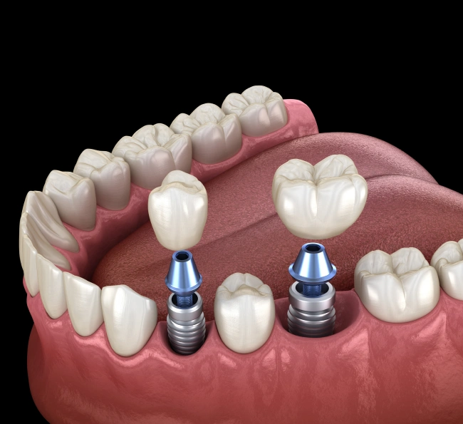 3D illustration of dental implants placed in the lower jaw with surrounding teeth