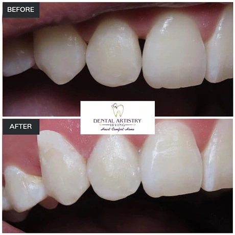 Before and after comparison showing results at Dental Artistry Irving